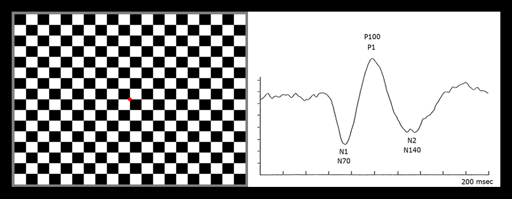 pattern reversal.jpg